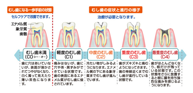 むし歯治療の4段階