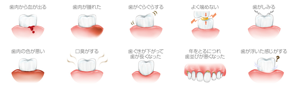歯周病の種類