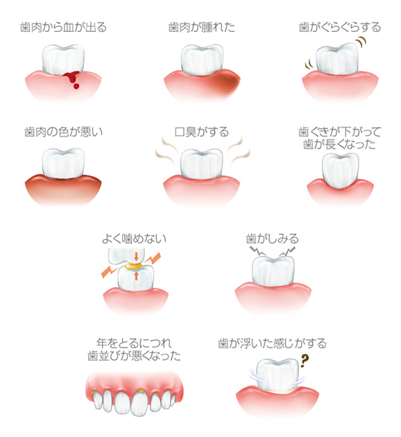 歯周病の種類