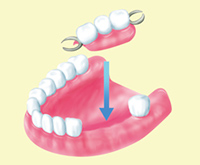 入れ歯